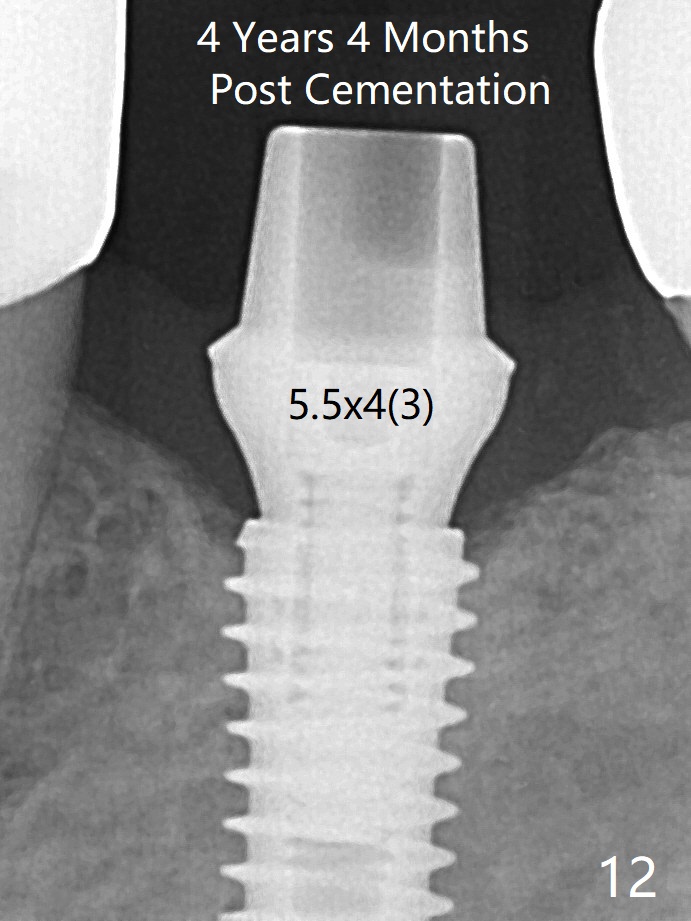 Non Immediate Implant of Lower 1st Molar with Ridge Split, Duluth